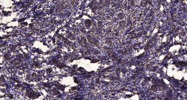 Immunohistochemical analysis of paraffin-embedded human Breast cancer. 1, Antibody was diluted at 1:200 (4°C overnight). 2, Tris-EDTA, pH9.0 was used for antigen retrieval. 3, Secondary antibody was diluted at 1:200 (room temperature, 45min).