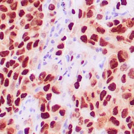 Human lung adenocarcinoma stained with anti-TTF-1 antibody using peroxidase-conjugate and DAB chromogen. Note the nuclear staining of tumor cells.