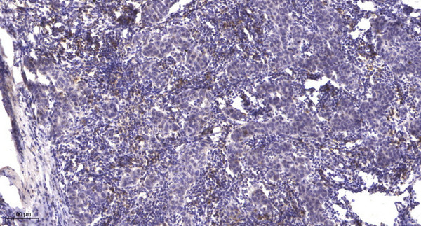 Immunohistochemical analysis of paraffin-embedded human Breast cancer. 1, Antibody was diluted at 1:200 (4°C overnight). 2, Tris-EDTA, pH9.0 was used for antigen retrieval. 3, Secondary antibody was diluted at 1:200 (room temperature, 45min).