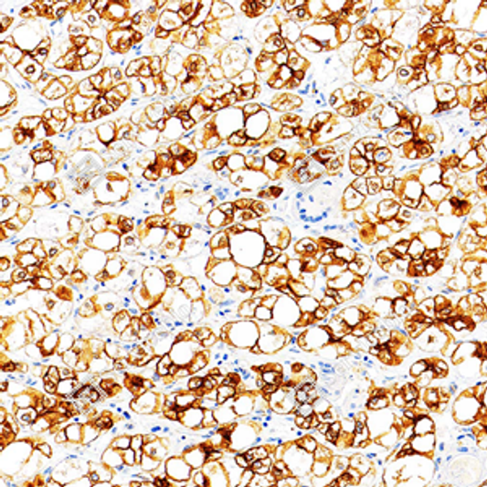 Immunohistochemistry analysis of Cytokeratin 18. Sample: Human liver cancer, 4% PFA 12-24h. Antigen retrieval: Citrate buffer, pressure cooker 2 min. Primary antibody: 1:500, 4C overnight. Secondary antibody: S-vision poly-HRP conjugated Goat Anti-mouse lgG, Ready to use, RT, 20min.