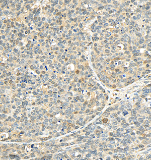 Immunohistochemistry analysis of P38. Sample: Human gastric carcinoma, 4% PFA 12-24h. Antigen retrieval: Citrate buffer, pressure cooker 2min. Primary antibody: 1:500, 4C overnight. Secondary antibody: HRP conjugated Goat Anti-Rabbit lgG, 1:200, RT, 1h.
