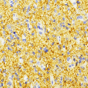 Immunohistochemistry analysis of Synaptophysin. Sample: Human glioblastoma multiforme, 4% PFA 12-24h. Antigen retrieval: TE buffer, 98C 20min. Primary antibody: 1:500, 4C overnight. Secondary antibody: HRP conjugated Goat Anti-Rabbit lgG, 1:200, RT, 1h.