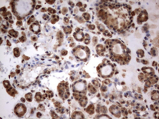 HMBS antibody immunohistochemistry human thyroid carcinoma STJA0033320