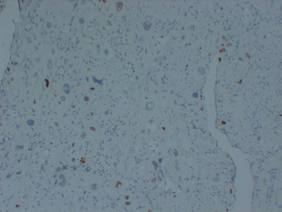 p57 Kip2 antibody immunohistochemistry partial hydatidiform mole STJA0033473