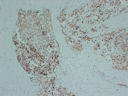 Androgen Receptor antibody immunohistochemistry prostatic carcinoma STJA0033506