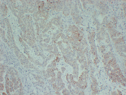 TGF beta Receptor II antibody immunohistochemistry colon carcinoma STJA0033543