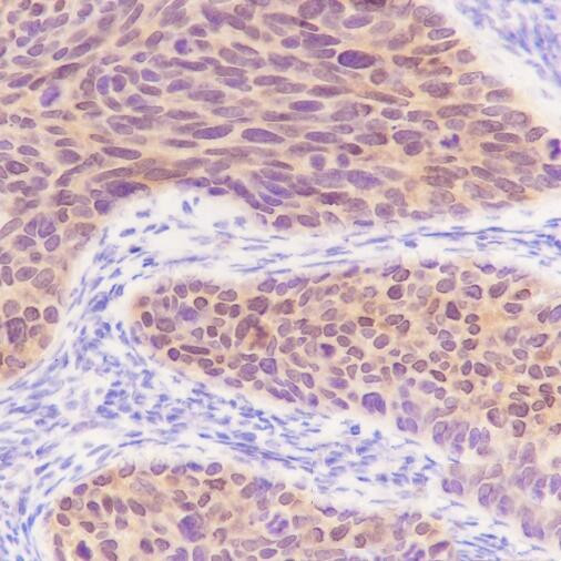 S100A2 antibody immunohistochemistry human cervical carcinoma STJA0033763