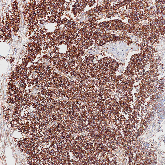 CD99 antibody immunohistochemistry Ewings sarcoma STJA0037584