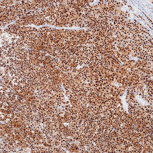 SOX10 antibody immunohistochemistry malignant melanoma paraffin-embedded STJA0037592