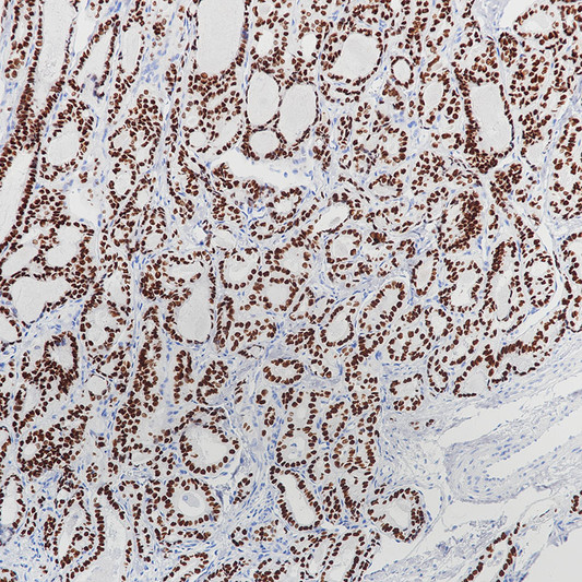 Thyroid Transcription Factor 1 antibody immunohistochemistry thyroid STJA0037633