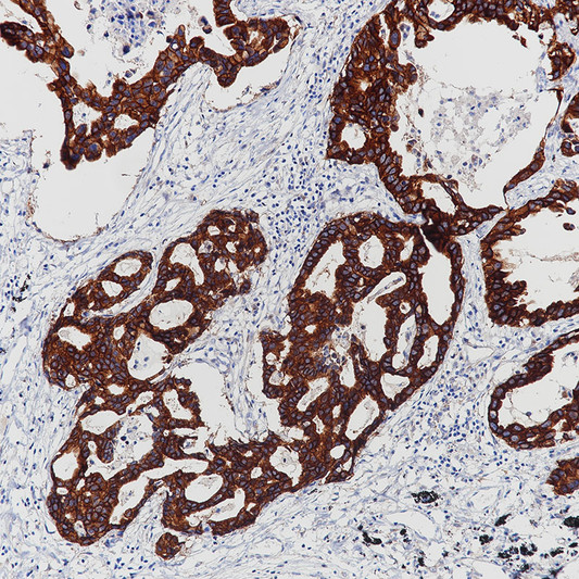 EGFR antibody immunohistochemistry lung adenocarcinoma STJA0037647