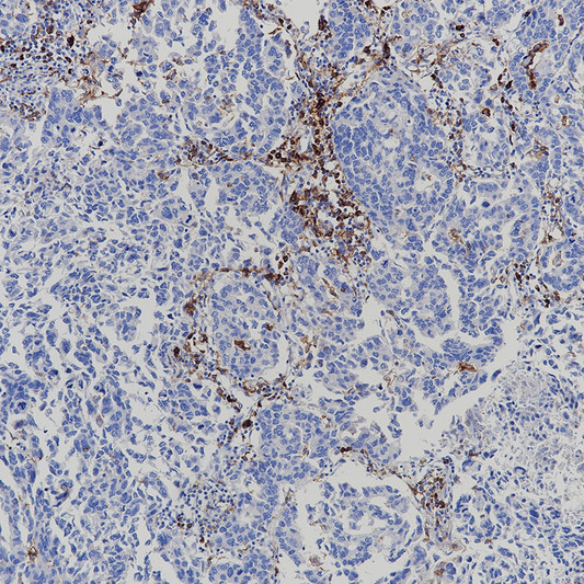CD14 antibody immunohistochemistry lung adenocarcinoma paraffin-embedded STJA0037654