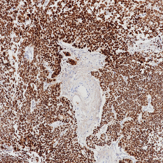 SOX2 antibody immunohistochemistry lung squamous cell carcinoma STJA0037665