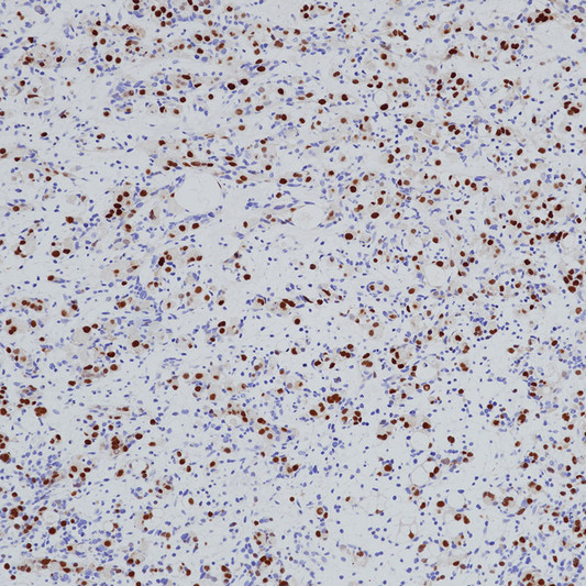 Myogenin antibody immunohistochemistry Embryonal Rhabdomyosarcoma STJA0037675
