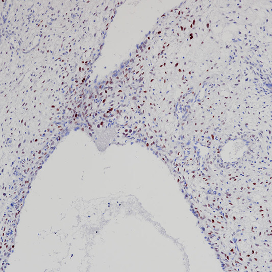 MDM2 antibody immunohistochemistry dedifferentiated liposarcoma paraffin-embedded STJA0037706