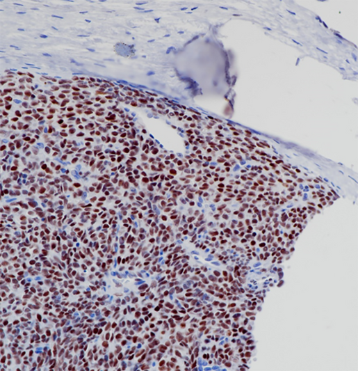 TLE1 antibody immunohistochemistry paraffin-embedded Synovial Sarcoma STJA0037719