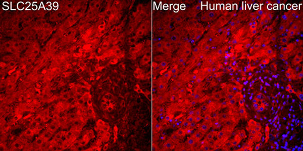 Immunofluorescence analysis of paraffin-embedded Human liver caner tissue using SLC25A39 Rabbit polyclonal antibody (STJ117645) at a dilution of 1:200 (40x lens). Secondary antibody:Cy3 Goat Anti-Rabbit IgG (H+L) at 1:500 dilution. Blue: DAPI for nuclear staining.