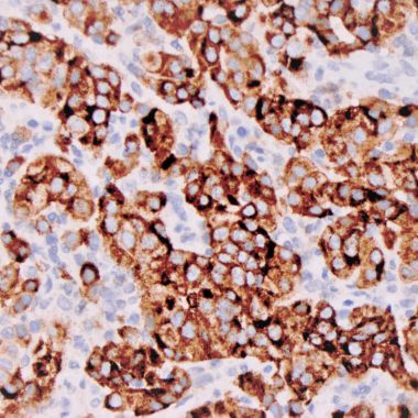 Anti-Melanosome antibody HMB-45 IHC antibody paraffin tissue