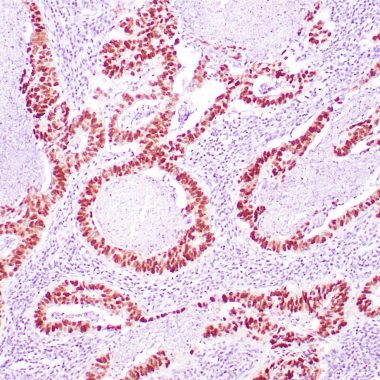 Anti-TP53 IHC staining