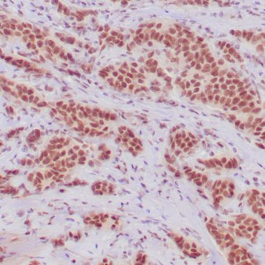 Anti-Recombinant-ER antibody IHC human breast adenocarcinoma