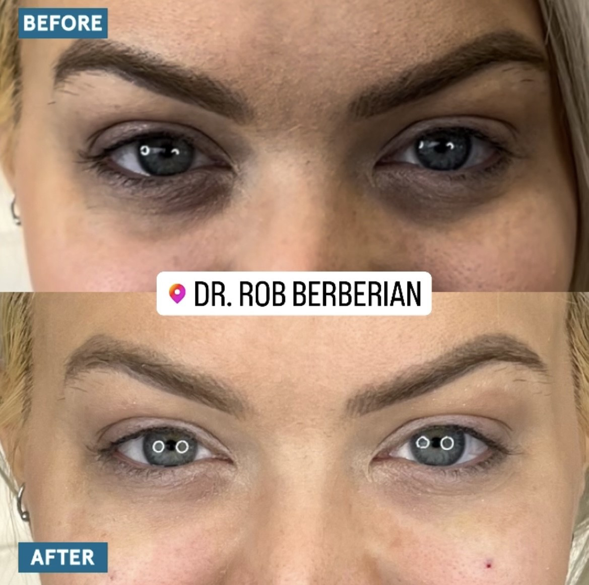 Celebrity Under Eye Treatment Package by Dr. Rob Berberian | Newport ...
