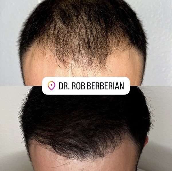 FUE Hair Transplant Timeline Los Angeles - Complete Recovery Guide | Dr ...