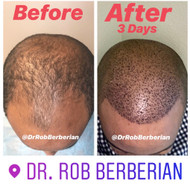 FUE Hair Transplant for African Amercian Curly Hair by Dr. Rob Berberian FUE Hair Transplant for African Amercian Curly Hair by Dr. Rob Berberian