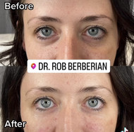 Shocking Celebrity Secrets Revealed: Under Eye Fillers Transforming Hollywood's Finest! Shocking Celebrity Secrets Revealed: Under Eye Fillers Transforming Hollywood's Finest!