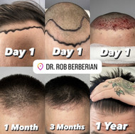 FUE Hair Transplant Growth & Progress Timeline: A Visual Representation of 2000 Grafts For Hairline Restoration FUE Hair Transplant Growth & Progress Timeline: A Visual Representation of 2000 Grafts For Hairline Restoration