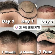 FUE Hair Transplant Progress Reditt with Photos