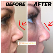 Nose Filler! Best Non-Surgical Rhinoplasty in Los Angeles! Dr. Rob Berberian Nose Filler! Best Non-Surgical Rhinoplasty in Los Angeles! Dr. Rob Berberian