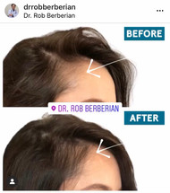 Unveiling the Secrets of PRP Facial and Hair Injections: Kisso Kisso Med Spa's Game-Changing Treatments for Flawless Skin and Luscious Hair! Unveiling the Secrets of PRP Facial and Hair Injections: Kisso Kisso Med Spa's Game-Changing Treatments for Flawless Skin and Luscious Hair!