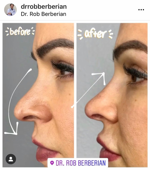 Non-Surgical Rhinoplasty Dr. Rob Berberian in Los Angeles & Orange County Non-Surgical Rhinoplasty Dr. Rob Berberian in Los Angeles & Orange County