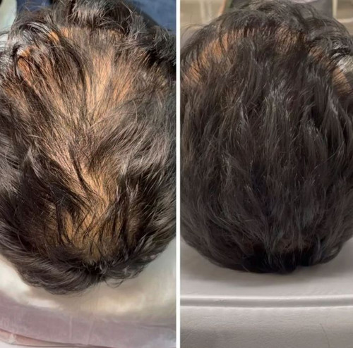 Scalp Micropigmentation SMP in Los Angeles and Orange County, Newport Beach, California. For a Free Consultation and a quote for SMP, simply text us your name and photos of your hair to: 424-744-3816