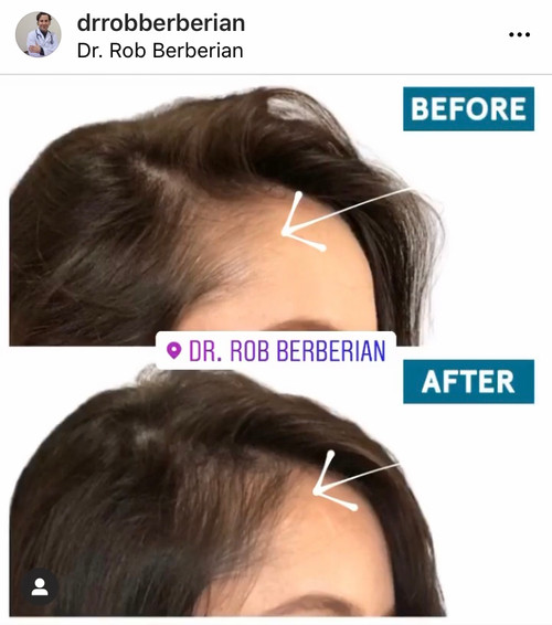 PRP Hair Injections Orange County & Newport Beach, CA Dr. Rob Berberian PRP Hair Injections Orange County & Newport Beach, CA Dr. Rob Berberian