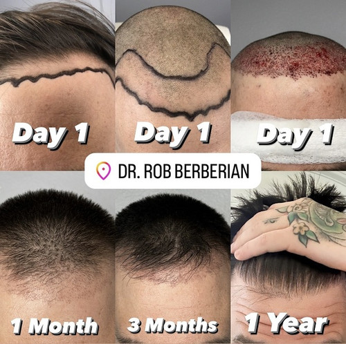 FUE Hair Transplant Timeline Reddit photos Dr. Rob Berberian in Los Angeles & Newport Beach Orange County California USA