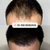 VIP FUE Hair Transplant Los Angeles & Orange County - Dr. Rob Berberian - Newport Beach 1000-4000 Grafts. No Shaving needed. Contact us for your free quote today!