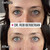 Before & After: Celebrity Under Eye Treatment Package by Dr. Rob Berberian Before & After: Celebrity Under Eye Treatment Package by Dr. Rob Berberian