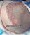 FUE Hair Transplant California - Los Angeles - Orange County - Dr. Rob Berberian FUE Hair Transplant California - Los Angeles - Orange County - Dr. Rob Berberian