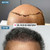 FUE Hair Transplant Los Angeles & Orange County - Dr. Rob Berberian - Newport Beach 1000-4000 Grafts. No Shaving needed. Contact us for your free quote today! FUE Hair Transplant Los Angeles & Orange County - Dr. Rob Berberian - Newport Beach 1000-4000 Grafts. No Shaving needed. Contact us for your free quote today!