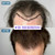 VIP FUE Hair Transplant Los Angeles & Orange County - Dr. Rob Berberian - Newport Beach 1000-4000 Grafts. No Shaving needed. Contact us for your free quote today! VIP FUE Hair Transplant Los Angeles & Orange County - Dr. Rob Berberian - Newport Beach 1000-4000 Grafts. No Shaving needed. Contact us for your free quote today!