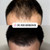 VIP FUE Hair Transplant Los Angeles & Orange County - Dr. Rob Berberian - Newport Beach 1000-4000 Grafts. No Shaving needed. Contact us for your free quote today! VIP FUE Hair Transplant Los Angeles & Orange County - Dr. Rob Berberian - Newport Beach 1000-4000 Grafts. No Shaving needed. Contact us for your free quote today!