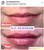 Lip Filler Los Angeles - Dr. Rob Berberian - Lip Injections