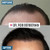 FUE Hair Transplant Timeline Los Angeles - Complete Recovery Guide | Dr. Rob Berberian