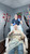 FUE Hair Transplant Timeline Reddit photos Dr. Rob Berberian in Los Angeles & Newport Beach Orange County California USA