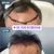 FUE Hair Transplant Timeline Reddit photos Dr. Rob Berberian in Los Angeles & Newport Beach Orange County California USA