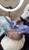 2000 Grafts FUE Hair Transplant Front to Crown by Dr. Rob Berberian in Los Angeles & Newport Beach California