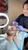 2000 Grafts FUE Hair Transplant Front to Crown by Dr. Rob Berberian in Los Angeles & Newport Beach California