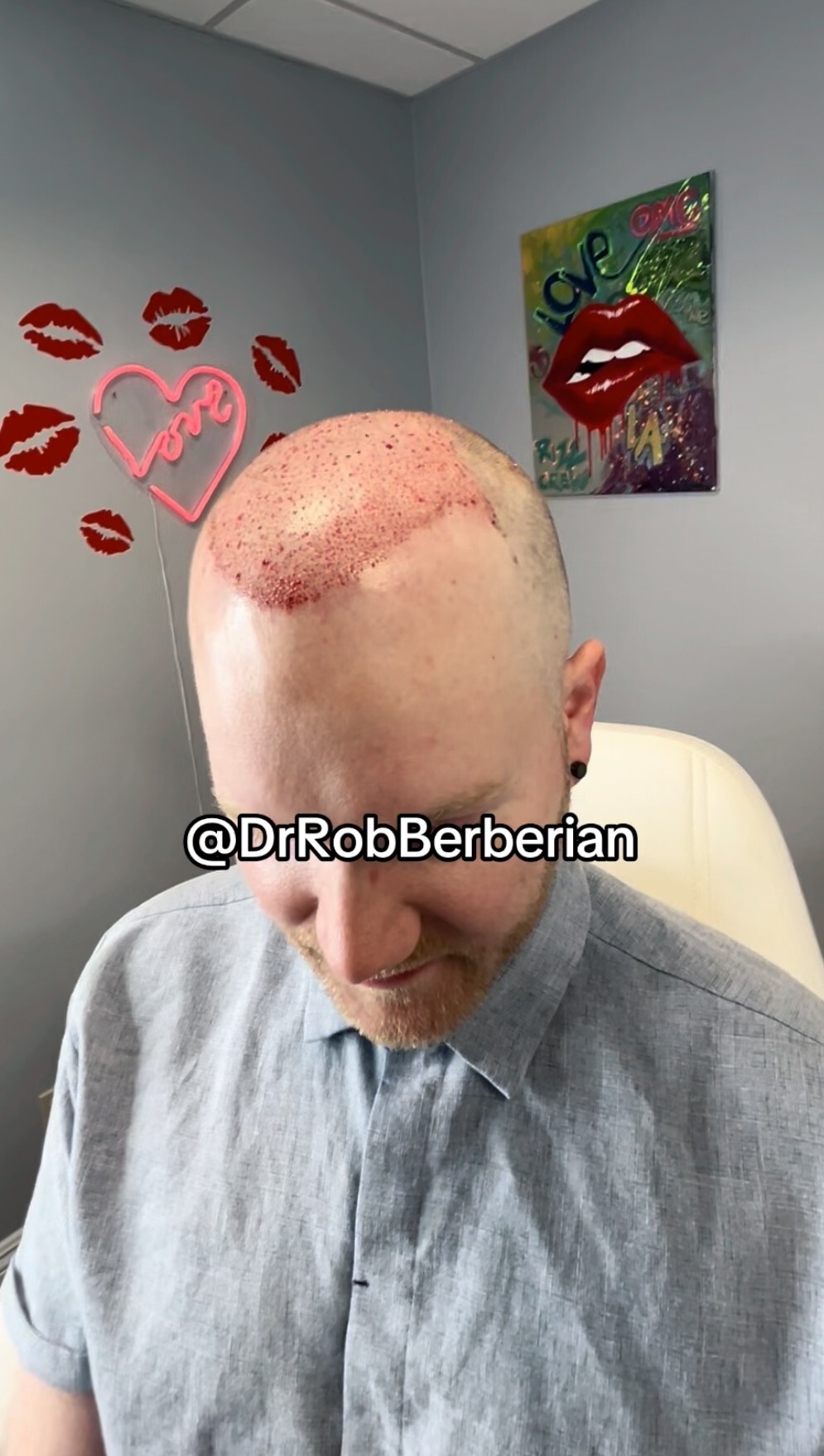 Hair Transplant Near Me Orange County Newport Beach Los Angeles California USA Dr. Rob Berberian