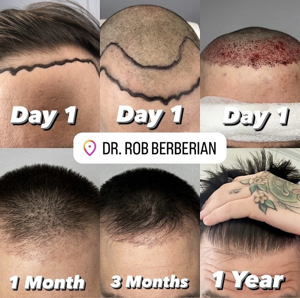 FUE Hair Transplant Progress Photo - Timeline - Dr. Rob Berberian in Los Angeles & Newport Beach, California